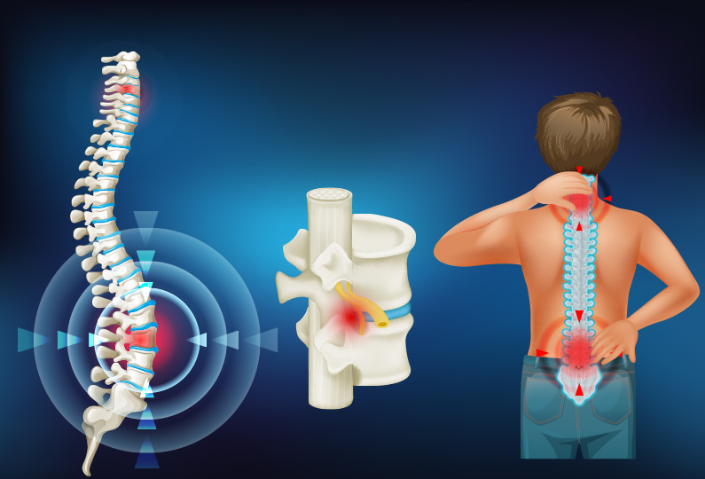 Lumbar Hernia