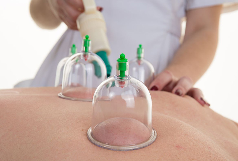 Cupping Treatment